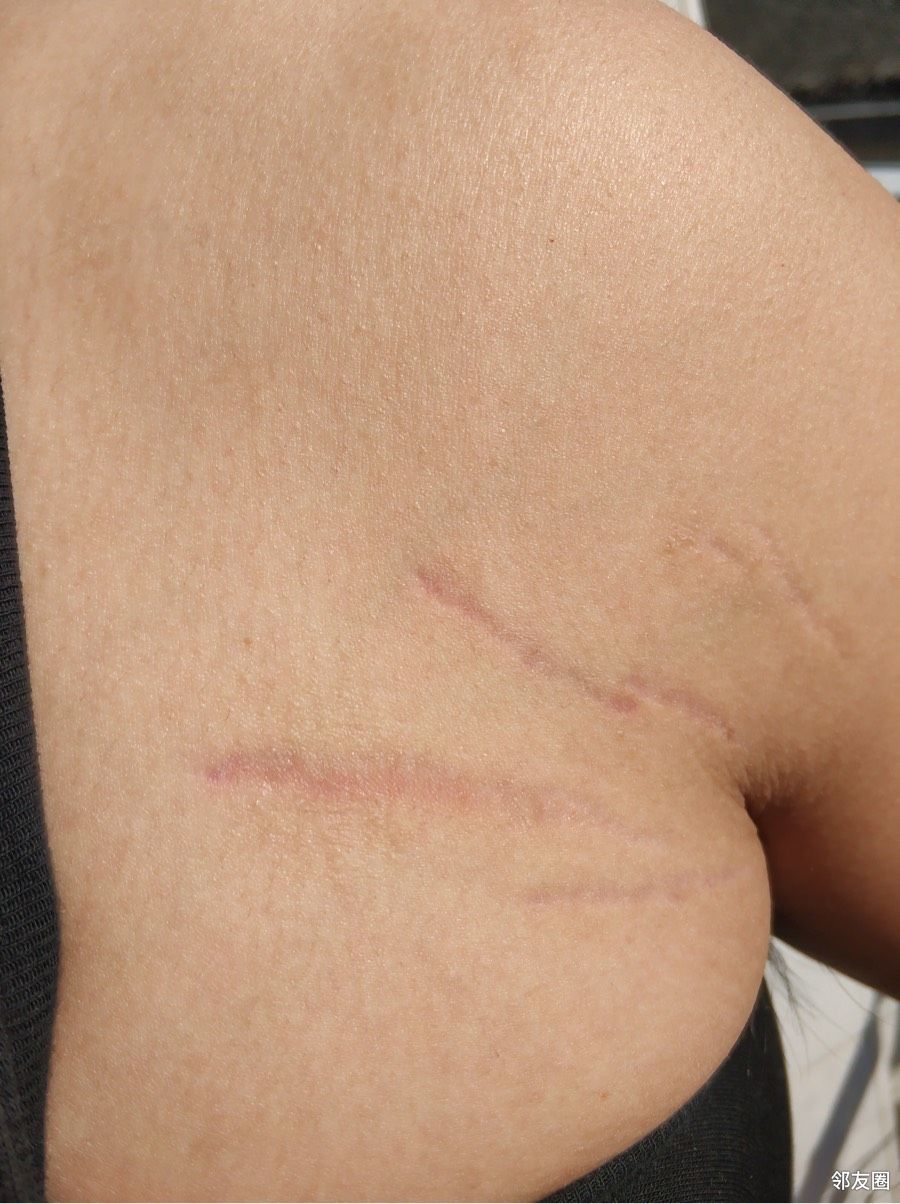 胳肢窝上面突然长出来很多裂痕是肥胖纹吗