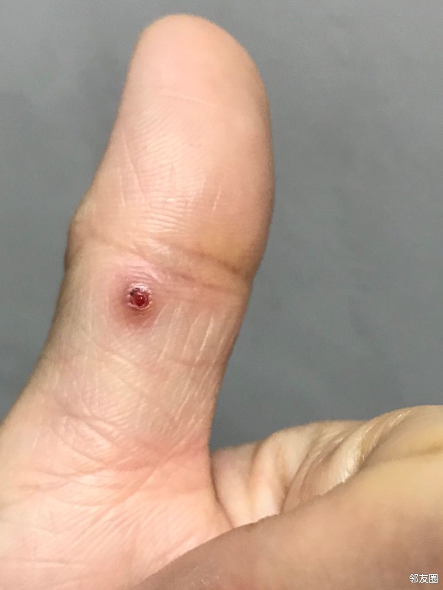 求助:大拇指内侧长了红色小包,碰到就流血,请问这是什么情况啊?