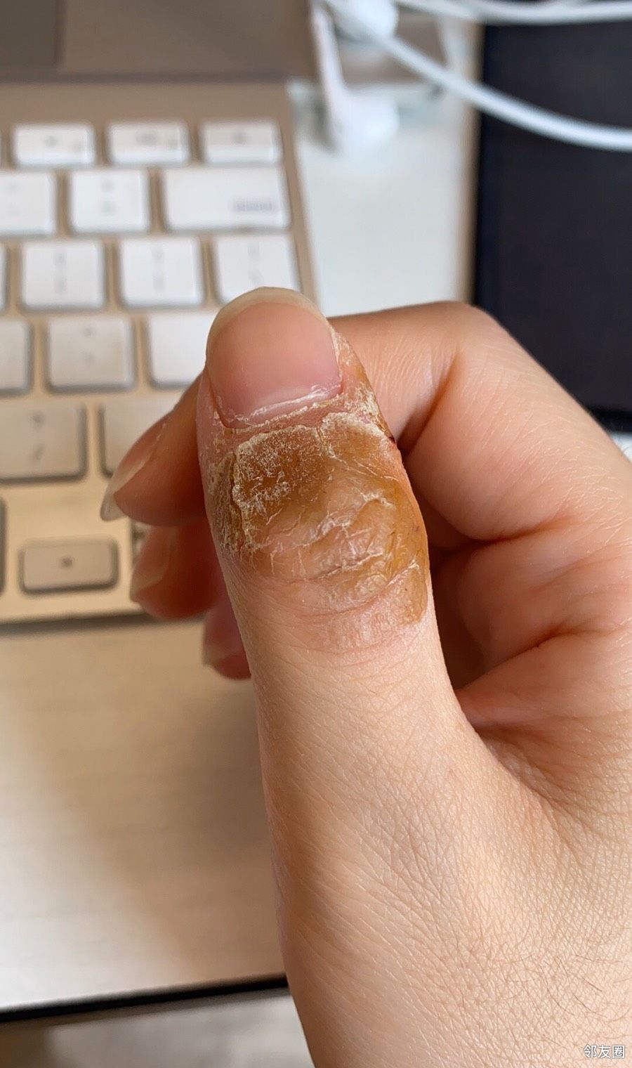 居然对创可贴过敏 - 生活杂谈 - 邻友圈 -