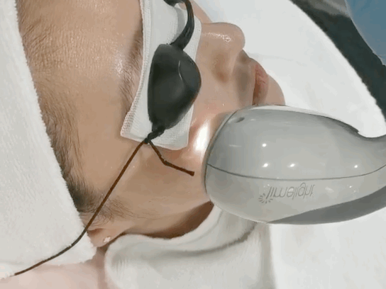 它跟其他光子嫩肤项目的明显区别是:它是滑着做的,不像原来"盖章"一